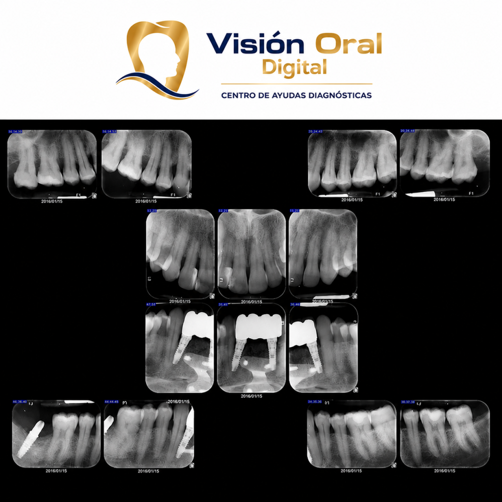 intraoral-acacias