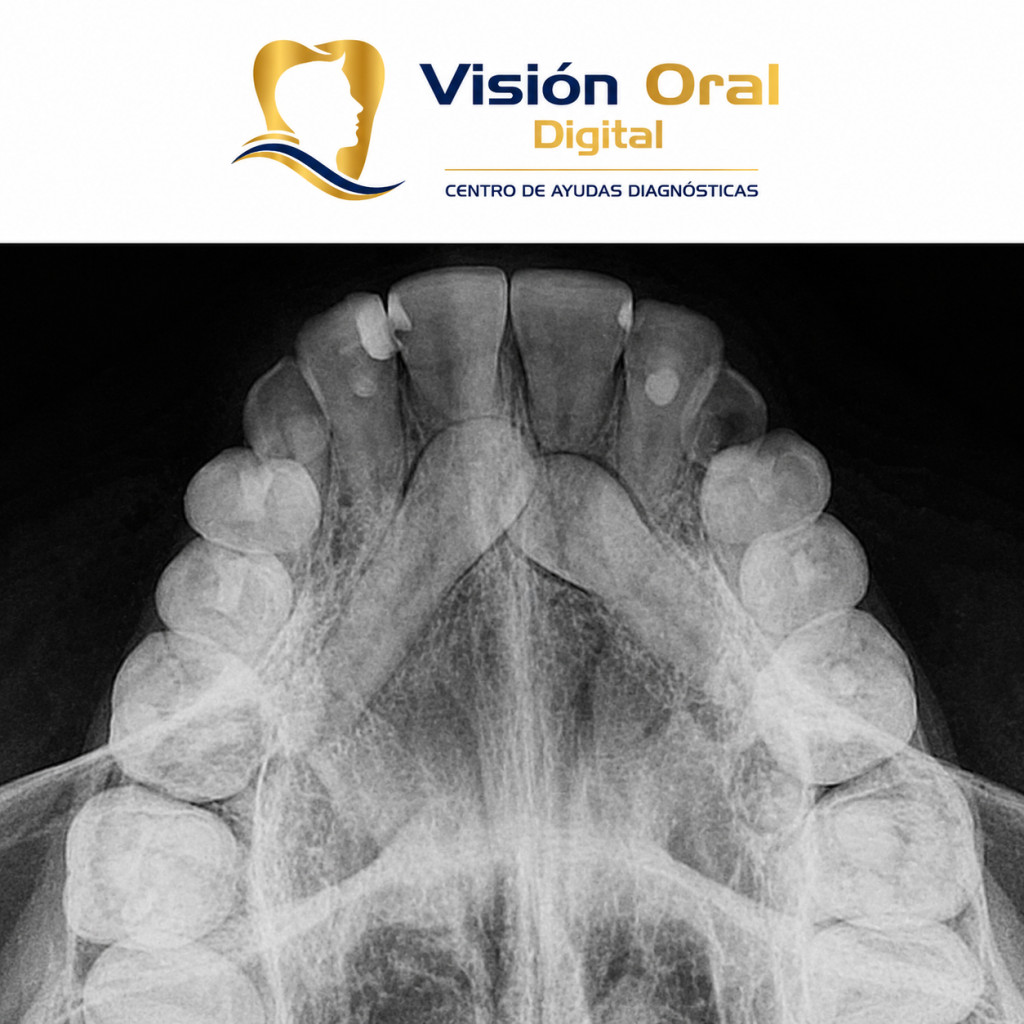 oclusal